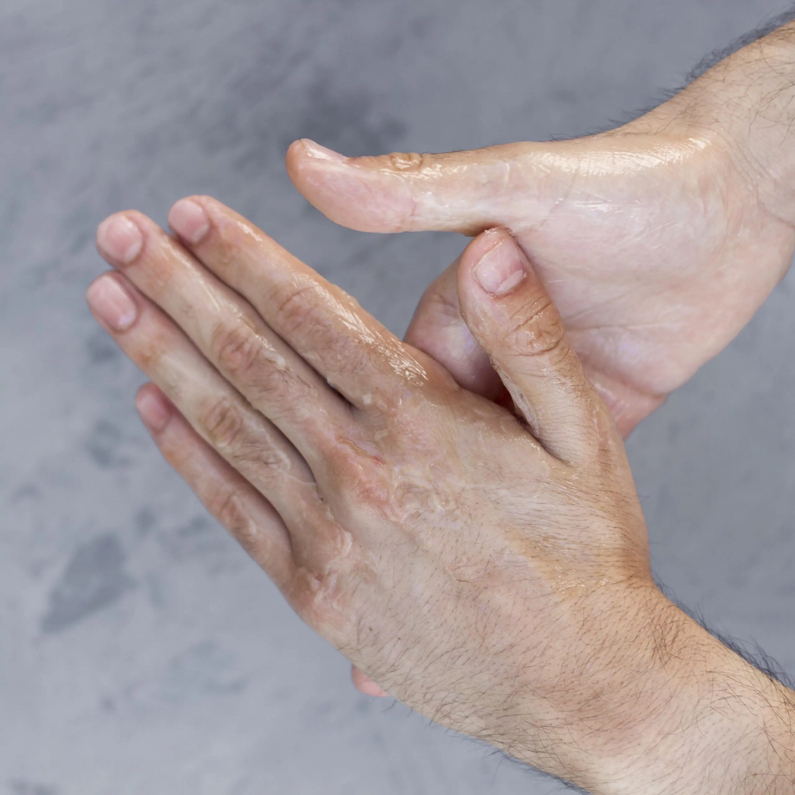 Palmar hyperhidrosis Treatment in Hyderabad