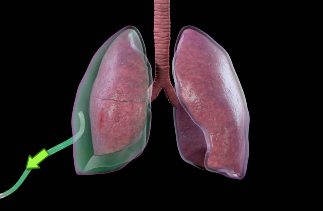 Pneumothorax Treatment in Hyderabad