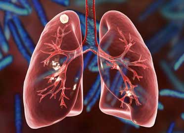 Post Tubercular Sequale