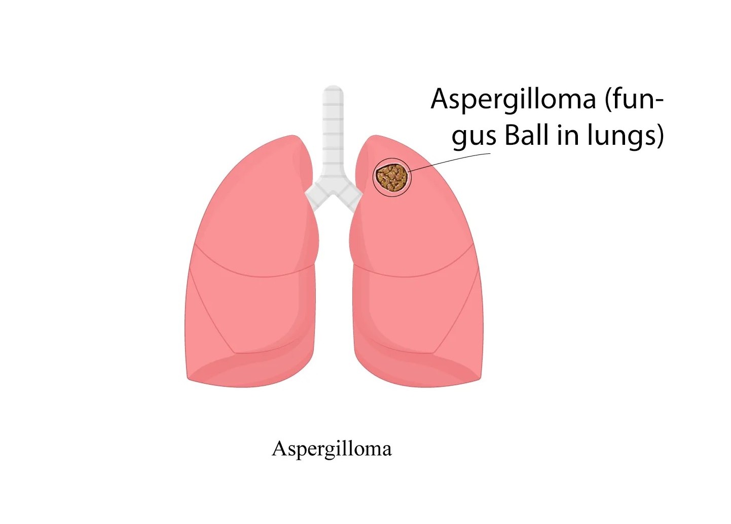 Aspergilloma Treatment in Hyderabad